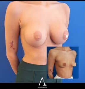 Augmentation mammaire chirurgie Alpha Esthetic Docteur Gasnier Docteur Dumas Nice Monaco