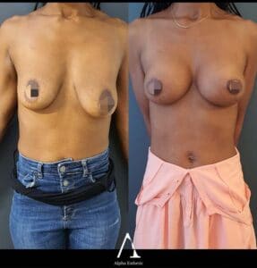 Lifting et Augmentation mammaire chirurgie Alpha Esthetic Docteur Gasnier Docteur Dumas Nice Monaco