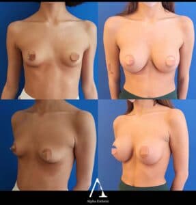 Augmentation mammaire chirurgie Alpha Esthetic Docteur Gasnier Docteur Dumas Nice Monaco