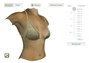 Simulation 3D dans l'augmentation mammaire par prothèses à Nice