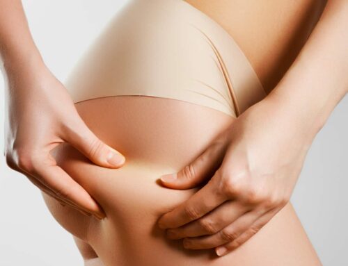 Liposuction: is it the right solution to reshape my silhouette?