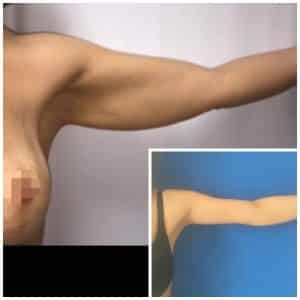 Témoignage Lifting bras
