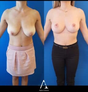 Lifting et Augmentation mammaire chirurgie Alpha Esthetic Docteur Gasnier Docteur Dumas Nice Monaco