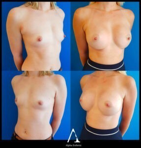 Chirurgie esthétique du sein : Augmentation mammaire