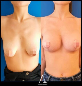 Chirurgie esthétique du sein : Augmentation mammaire