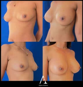 Chirurgie esthetique du sein Augmentation mammaire