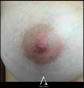 Exemple de cicatrice périaréolaire semi-circulaire sur augmentation mammaire