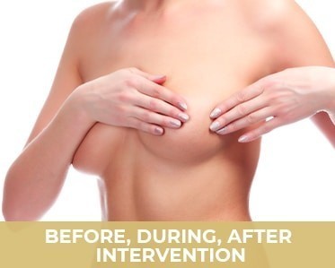 Aesthetic breast surgery intervention